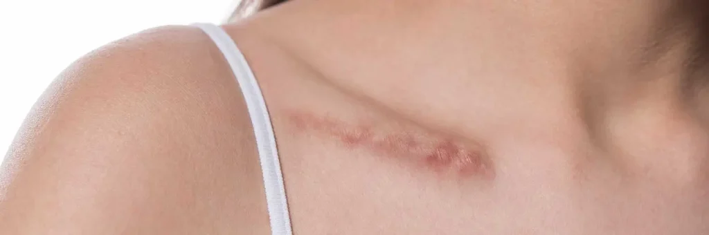Scar Reduction